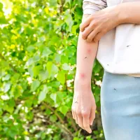 Someone Standing in the Yard Scratching at Mosquito Bites